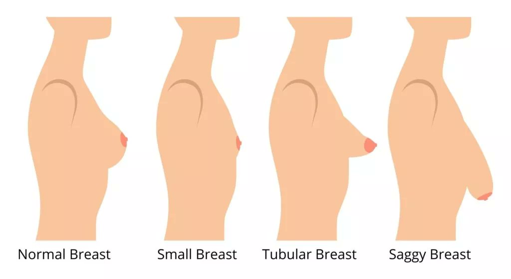 dinocrusher's tweet photo. This is a visualisation of what Tubular breast looks like in case you need a reference. 

I just had to come back to warn my trans friends about this rq, GGP is in the shitter and for reasons such as this don’t trust them. https://t.co/bpOHdVvi3j