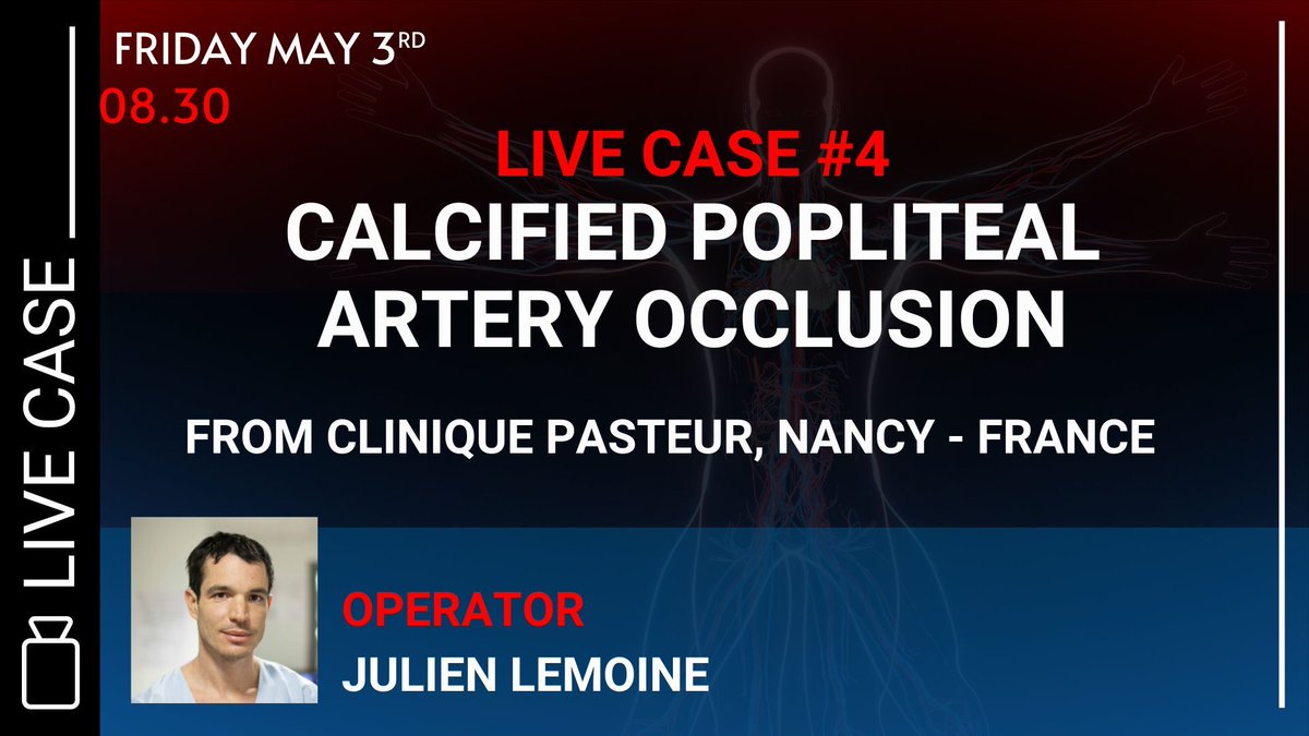 Don’t miss the Live case 4 from Clinique Pasteur 🇫🇷 on Friday, May 3rd at 8.30 AM!

Julien Lemoine will perform this case on “Calcified popliteal artery occlusion” and share with you his expertise. 

Register ➡ swll.to/register-MLEND…

#MLCTOENDO2024 #endovascular #vascular #CTO