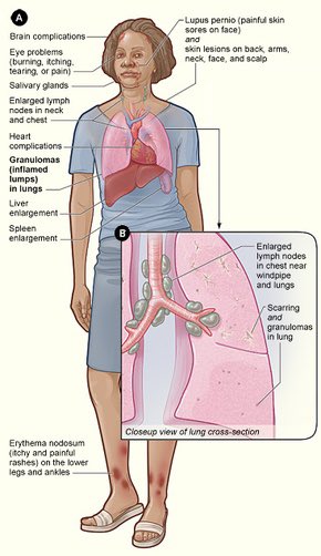 سؤال يعتبر ٥ نجوم في STEP 1 USMLE 

وش المكنزم لل Hypercalcemia في ال 
Sarcoidosis