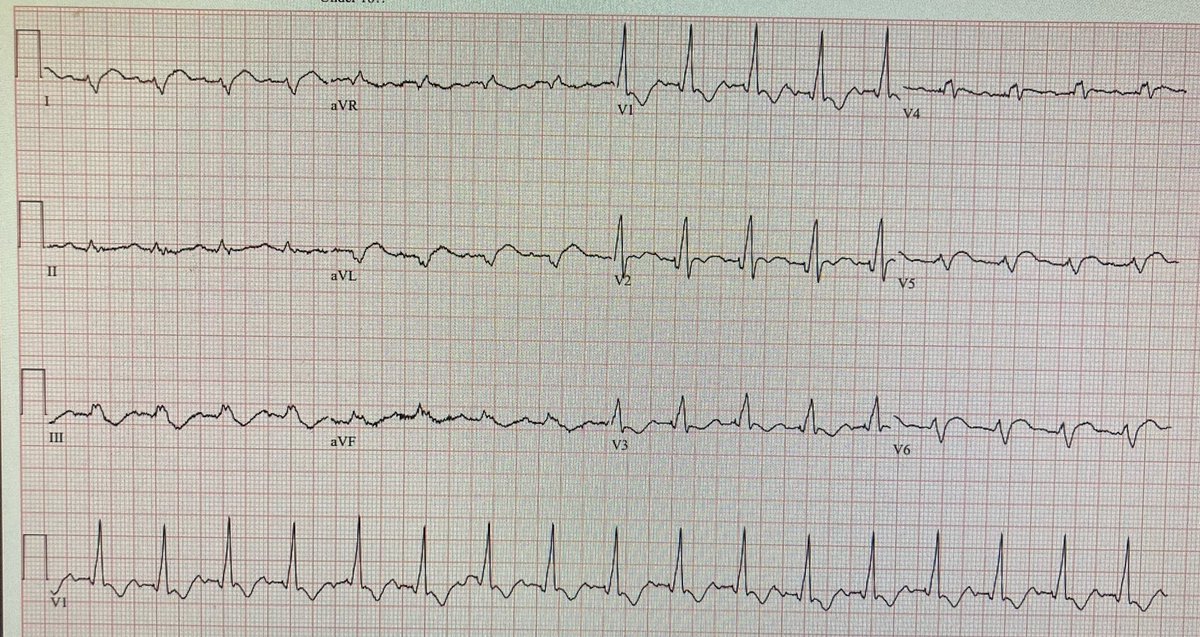 The current STEMI paradigm: Because STEMI criteria are not met, let's wait until the myocardium is dead!!

hqmeded-ecg.blogspot.com/2024/04/the-cu…