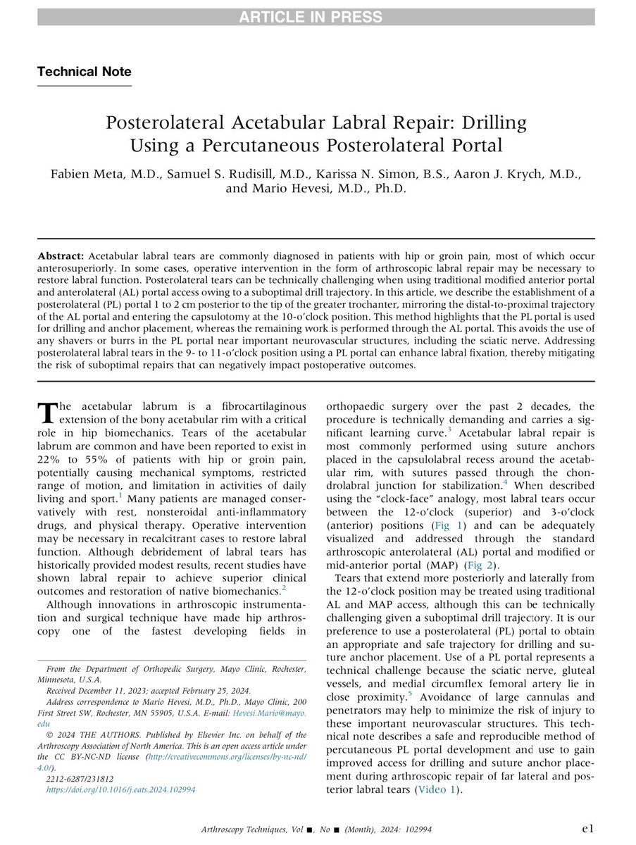 Hot off the press. Tips and tricks for achieving satisfactory hip arthroscopic #LabralRepair for tears that go far posterolaterally using a percutaneous posterolateral drilling portal. sciencedirect.com/science/articl…