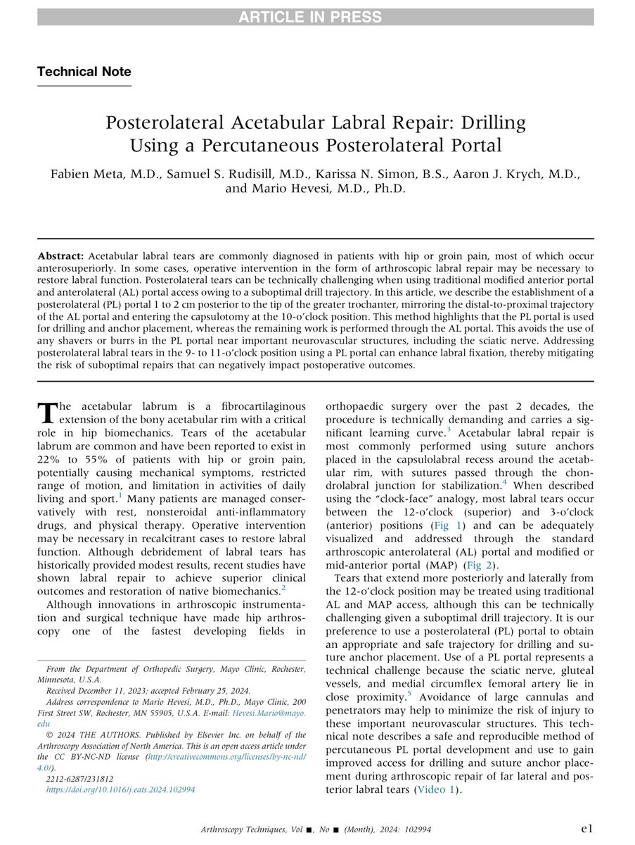 Hot off the press. Tips and tricks for achieving satisfactory hip arthroscopic #LabralRepair for tears that go far posterolaterally using a percutaneous posterolateral drilling portal.

sciencedirect.com/science/articl…
