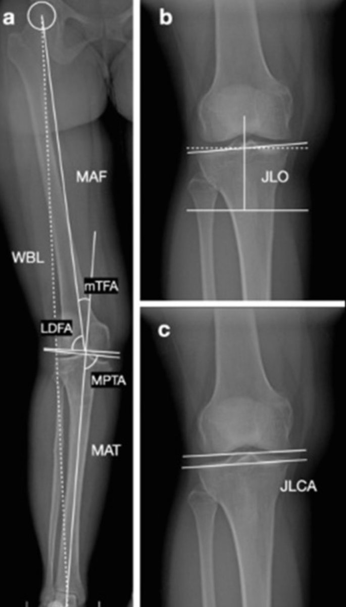 Here’s a paper: osteotomies in orthopedic surgery part I & II @J_ISAKOS @ISAKOS pubmed.ncbi.nlm.nih.gov/38460600/ pubmed.ncbi.nlm.nih.gov/38604568/ #knee #osteotomy #HTO #DFO #jointpreservation #alignment #slope #ACL #JISAKOS