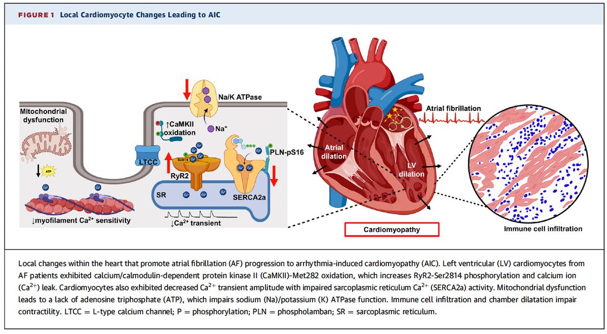 📚JACC STATE-OF-THE-ART REVIEW Arrhythmia induced #cardiomyopathy 🔹Noxae acting on a vulnerable substrate 🔹Usually reversible, but may recur 🔹Multiple mechanisms involved👇 🖇️tinyurl.com/32873d3v @XWehrens @joshua_A_keefe @JACCJournals #Epeeps #JACCHF #JACCEP