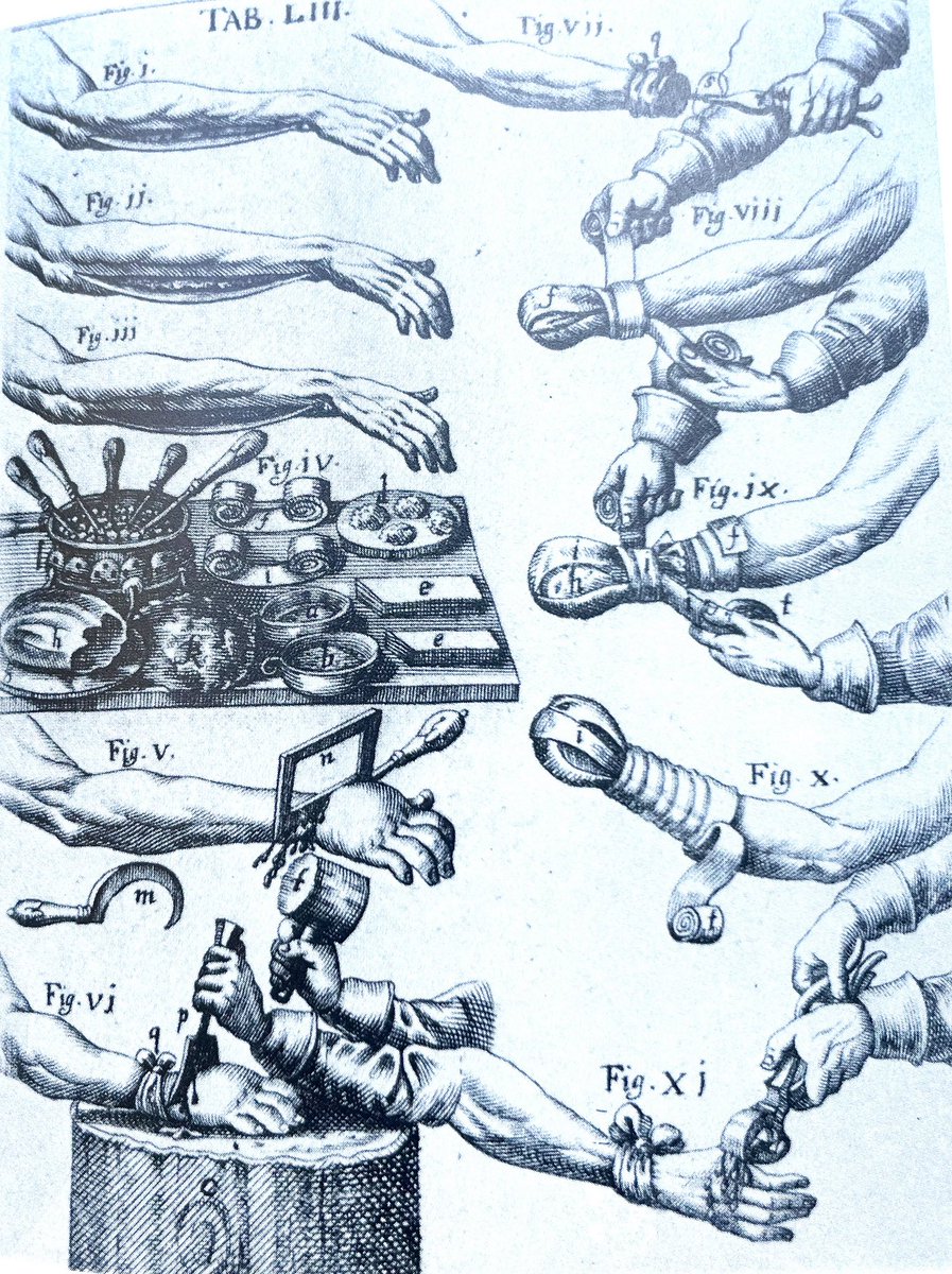 A short message to those who think that science does not improve the human condition: Take the long view. Here is an illustration of how hand and thumb amputations were performed 350 years ago. No anesthetic. Notice the hot coal to heat the cauterizing irons.