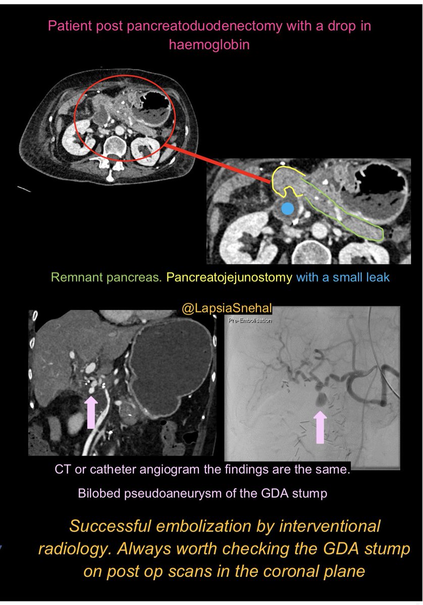 Post op pancreaticoduodenectomy bleeding. Always check the GDA stump! #FOAMrad #FOAMed #meded #radres #futureradres #medstudenttwitter #gitwitter #anatomy #frcr #surgery #radiology #radtwitter #medtwitter #hpb #pancreas #hbp