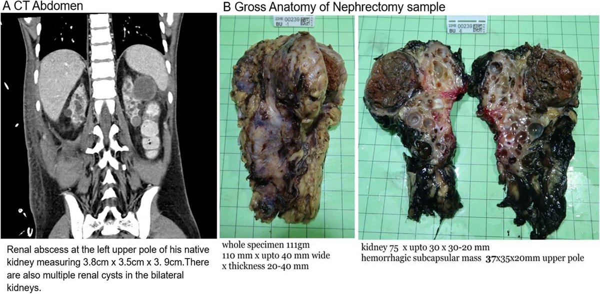 Acquired cystic kidney disease (ACKD) can occur in patients w/CKD & kidney failure, & its incidence increases w/dialysis duration. Read these Clinical Insights on prevalence of ACKD in children. link.springer.com/article/10.100…