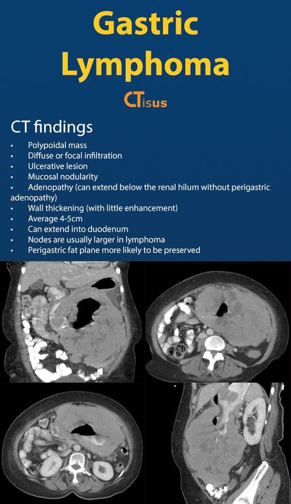 Gastric Lymphoma: CT Findings