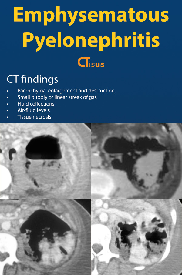 Emphysematous Pyelonephritis: CT Findings