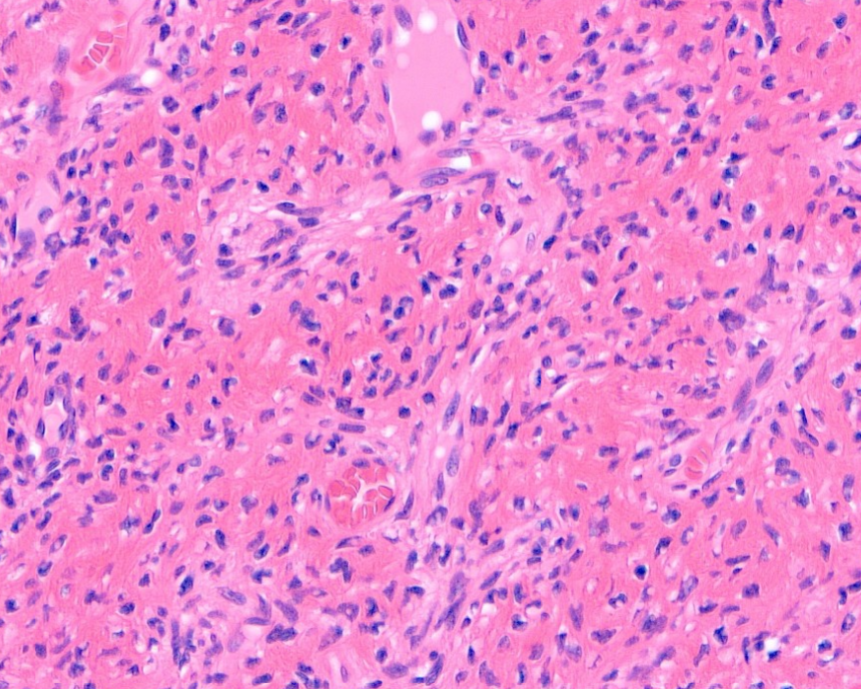 ✅Denosumab treated giant cell tumor of bone.
Denosumab inhibits the formation of osteoclasts (giant cells) and the neoplastic cells (mononuclear ones) that have an osteoblastic phenotype start forming bone in this peculiar fibrillar pattern
Dr. Nielsen #USCAP2024 #BSTPath…