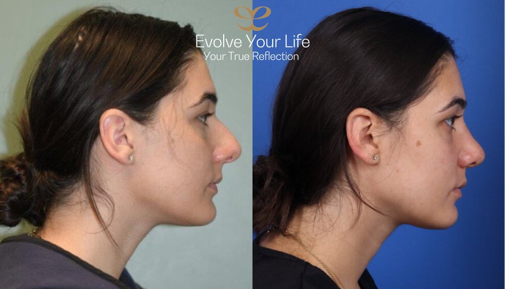 EvolveYourLife_'s tweet photo. This lovely lady presented for a rhinoplasty. She is very happy with her new nose and balanced features! 

☎️ (312) 278-9000 
📧 info@evolveyourlife.com 
🌐 https://t.co/LXmWRveTz6 

#rhinoplasty #nosejob #evolveyourlife #beforeandafter #plasticsurgery #plasticsurgeon https://t.co/xrHBddjIkH