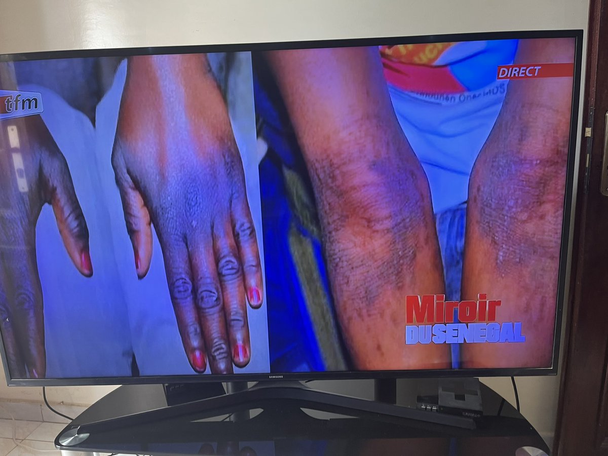 MariamTendou's tweet image. Décidément c’est la totale! Après la matinale, une seconde émission 100% femmes “Miroir du Sénégal “ avec des femmes spécialistes médecins, artistes aux multiples expertises —complètement dédiée à la sensibilisation sur la “ #depigmentation volontaire artificielle de la peau au…