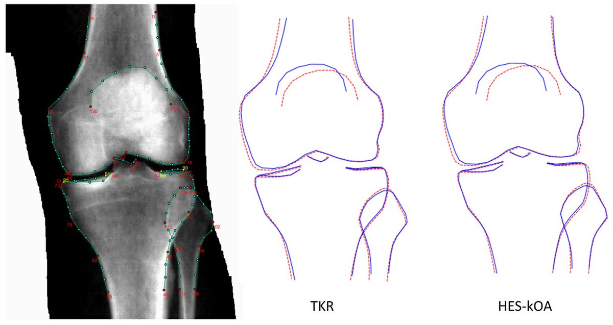 Interested in a potential DXA-based imaging biomarker for knee replacement surgery? Our latest results based on data from @uk_biobank are now available (open access): sciencedirect.com/science/articl…