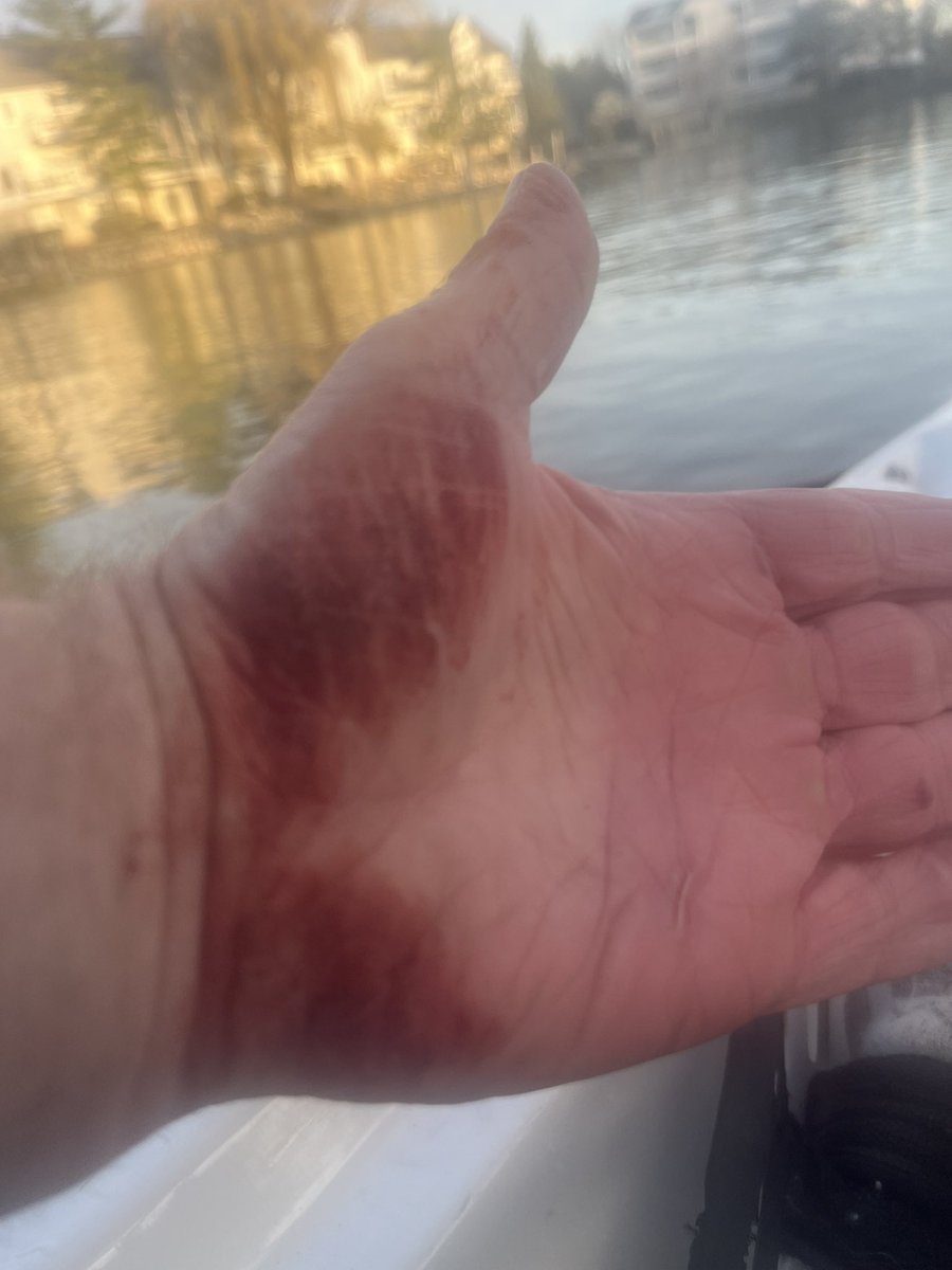 Motor boat wakes in abundance this morning. Bc your hands in sculling (rowing with an oar in each hand) cross over each other, it the wake hits at the right moment the top hand nicks the bottom and then you rub the top hand across the bleeding bottom each subsequent wake