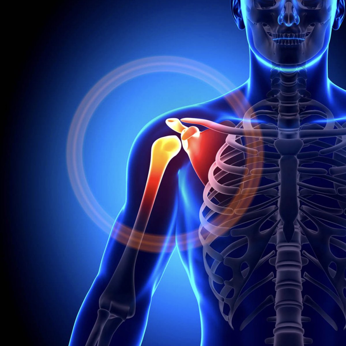 The most common cause of shoulder pain: Shoulder impingement. It accounts for 44% to 65% of all shoulder complaints. Here are 5 exercises to reduce pain (and increase strength):