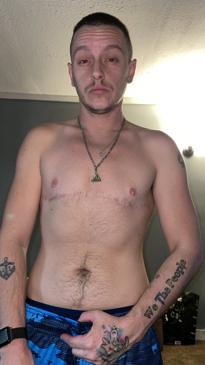 GalaxyBoy89's tweet photo. My scars are a part of my journey and I am grateful for them. 🏳️‍⚧️ When I look in the mirror now, I see the man that’s been trapped for so long, finally shining through. 🫶🏼 #ftm #topsurgery #visibleforthosewhocantbe https://t.co/5hou5b6ETu