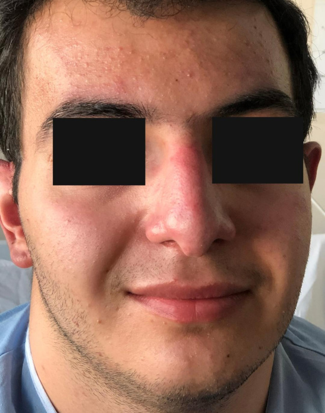 New‐onset systemic lupus erythematosus

A 21‐year‐old man presented with an erythematous skin rash on his cheeks, ears, and the bridge of his nose  and experienced right knee arthralgia 2 days after receiving the second dose of the #Sinopharm  vaccine.
europepmc.org/article/MED/38…