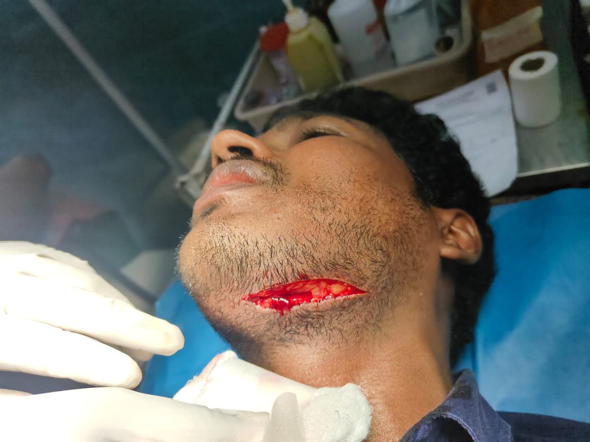 Dr. Naveen, working at Pondicherry Government Hospital, was stabbed in the neck by a relative of a patient, highlighting the urgent need to stop violence against doctors.

#MedTwitter #MBBS #NEETPG #NEET