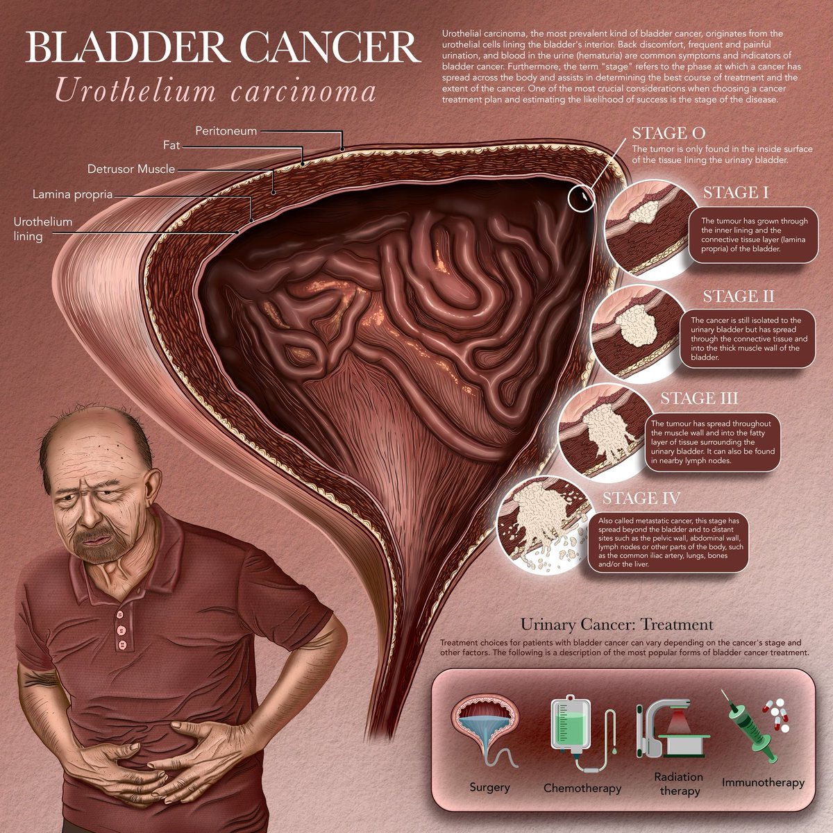 My second illustration for the <a href="/AMIdotorg/">AMI</a> sponsored by <a href="/JNJNews/">Johnson & Johnson</a> is of bladder cancer (urothelial carcinoma)! 🧫

I’ll be posting a different illustration each month (you can see and download all of the illustrations at illustratechange.com)