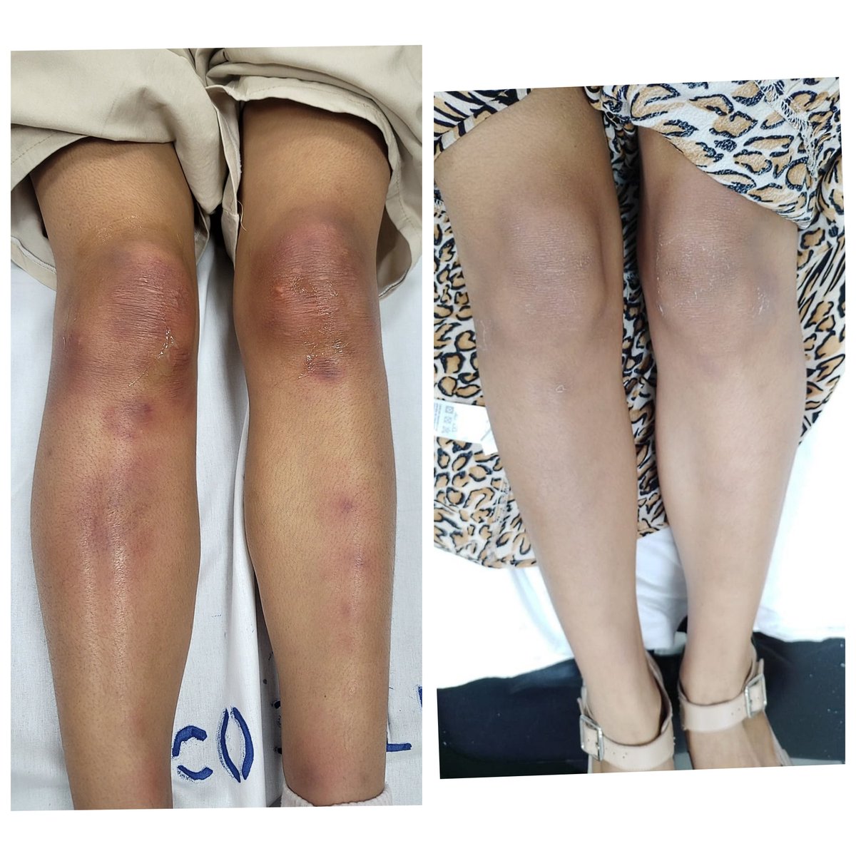 ConsejosReumato's tweet photo. El #eritemanudoso es una #paniculitis septal que produce lesiones eritematosas, dolorosas, elevadas (a veces coalescen alrededor de las articulaciones), se localizan mayormente en miembros inferiores. La paciente acudió con estas lesiones y mejoró luego de 3 días con reposo,AINE. https://t.co/xeo1Dkli7U