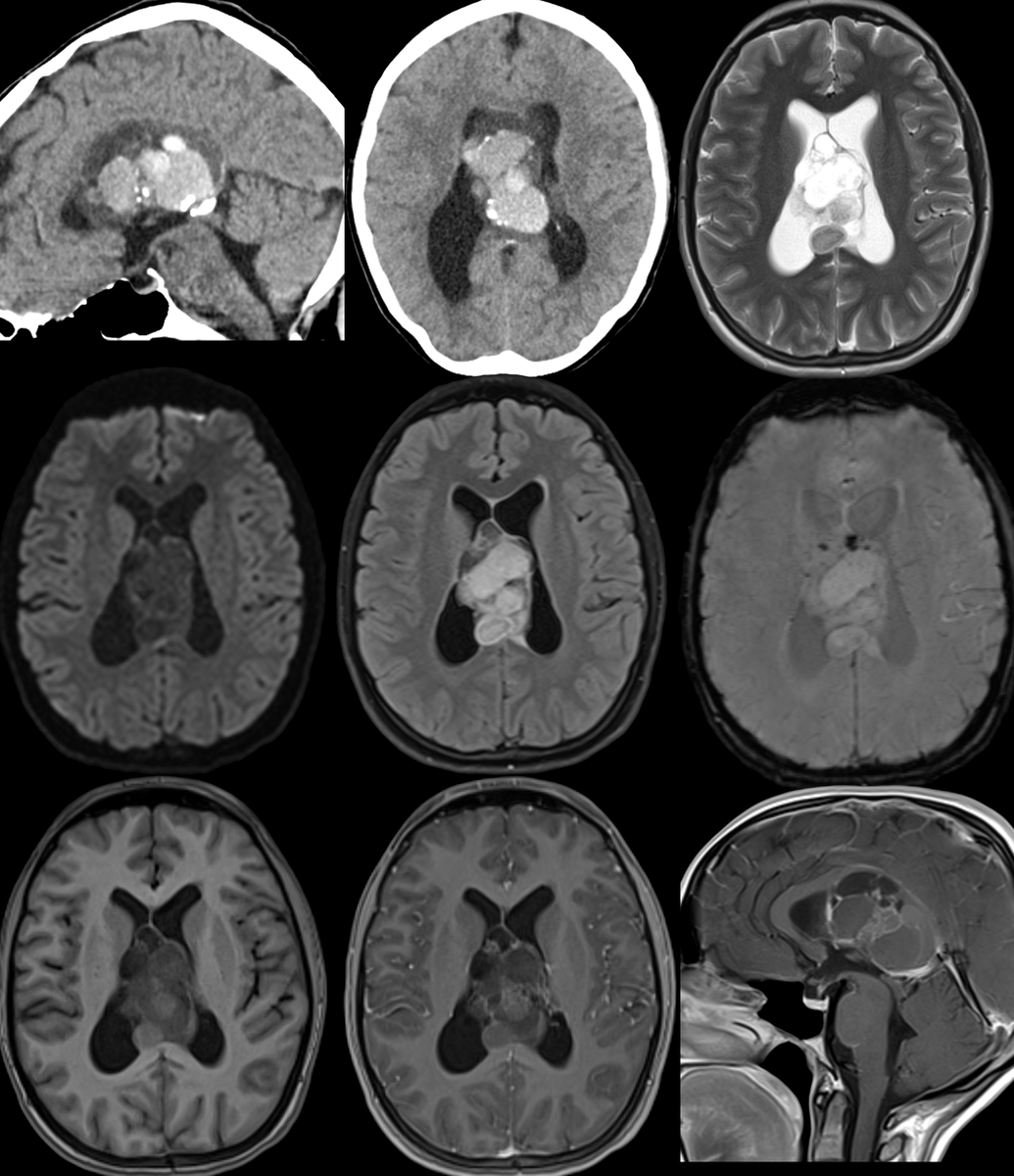 20s male patient presents with sx of hydrocephalus and this lesion is found on imaging. Original read suggested central neurocytoma. Biopsy non-diagnostic, revealing only mucin. CT C/A/P negative. What do you think?
