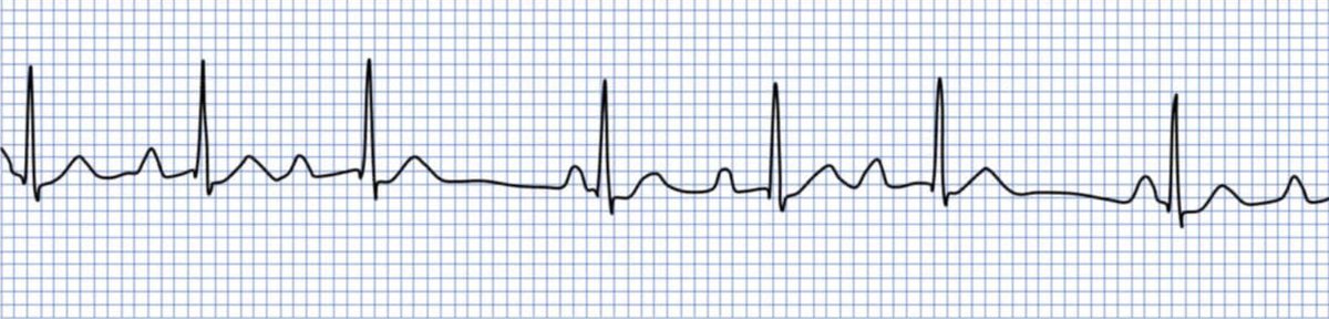 It's a shame that I can't seem to remember everything all the time. In an effort to keep this fact in mind, here's a short educational thread on RR-intervalls in Type I 2nd degree AV-Block (in Germany we like to call it Wenckebach).  1/