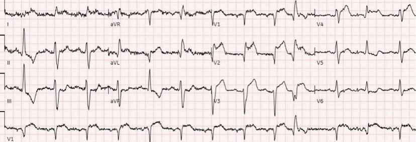 90 year old, prior MI, with weakness. Is this just an old MI? 
#ECG #EKG #FOAMed #MedEd #medstudent #resident #paramedic #EmergencyMedicine #CardioTwitter