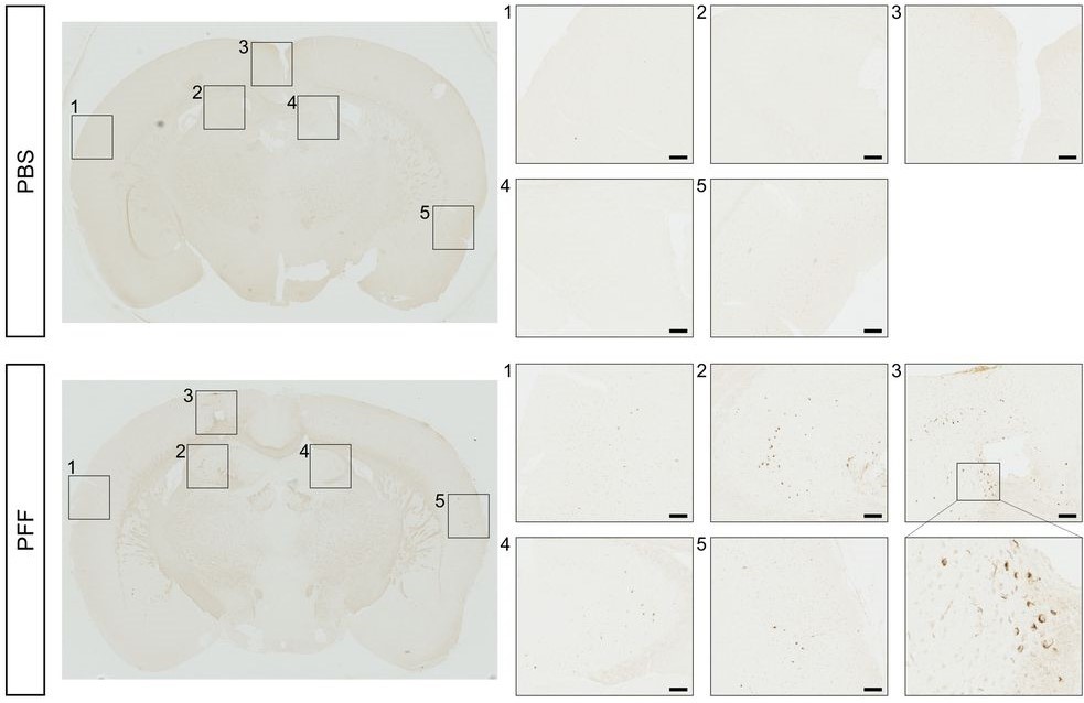 #eNeuro: <a href="/charyssevdd/">Charysse Vandendriessche</a> <a href="/ArnoutBruggeman/">Arnout Bruggeman</a> et al. <a href="/Vdb_lab/">Vandenbroucke lab</a> investigated the spreading &amp; effects of seeding-competent, recombinant α-syn preformed fibrils (PFF) in the CSF of mice. The choroid plexus &amp; CSF were identified as important players in PD pathology.
eneuro.org/lookup/DOI/10.…