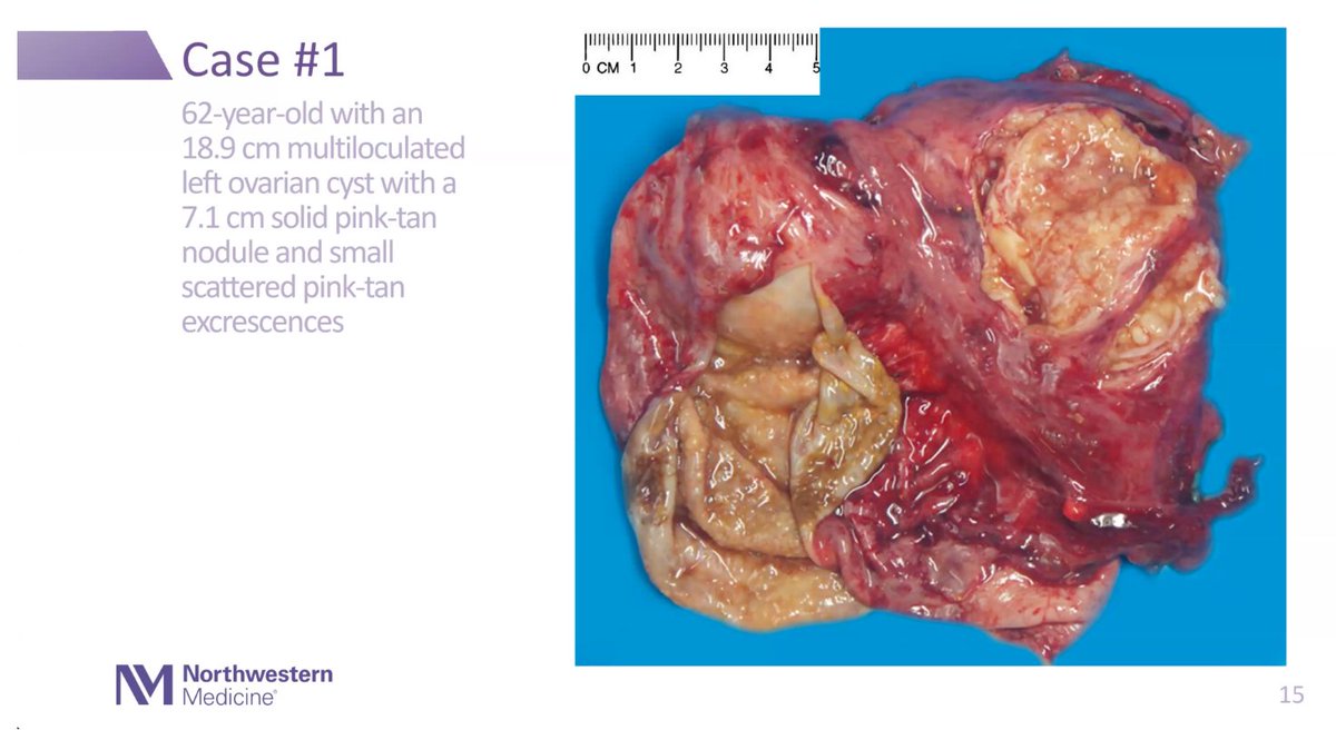 ⚠️⚠️A practical approach to FROZENS for OVARIAN lesions, DIAGNOSTIC TIPS below 🧵👇 @ISGynP @LuisBlancoJrMD #GYNpath #PathWebinarPearls (1/11) 📌 hierarchical branching 📌bland pseudostratified nuclei