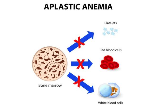 GiaPratamaMD's tweet photo. Lagi ramai bahas Anemia Aplastik dan beberapa obat2an sakit kepala yg beredar di pasaran, yuk kita bahas.

Anemia aplastik itu kondisi LANGKA dimana sumsum tulang tidak memproduksi cukup sel darah merah, putih, dan trombosit. Penyebabnya macam2 tapi terseringnya adalah Autoimun. https://t.co/AxQha17zV0