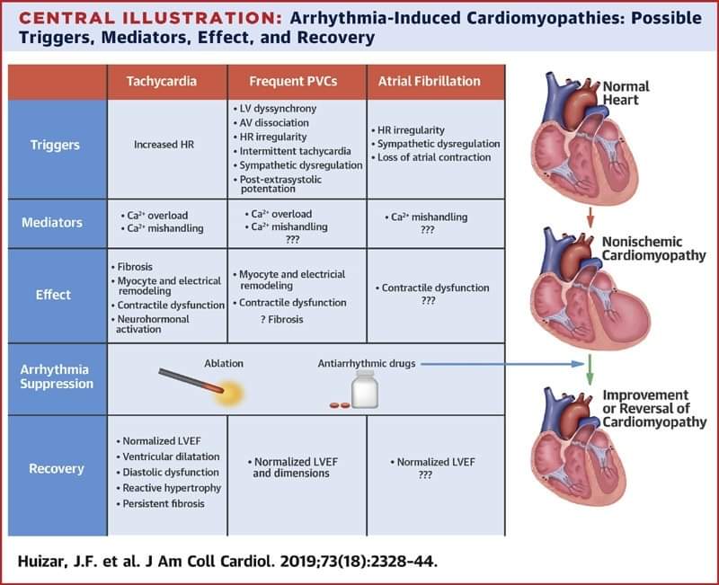🔴 Arrhythmia-Induced Cardiomyopathy: JACC State-of-the-Art Review #openaccess @JACCJournals sciencedirect.com/science/articl… #CardioTwitter #CardioEd #cardiology #cardiovascular #FOAMed #meded #medtwitter #cardiotwiteros #medx #paramedicstudent