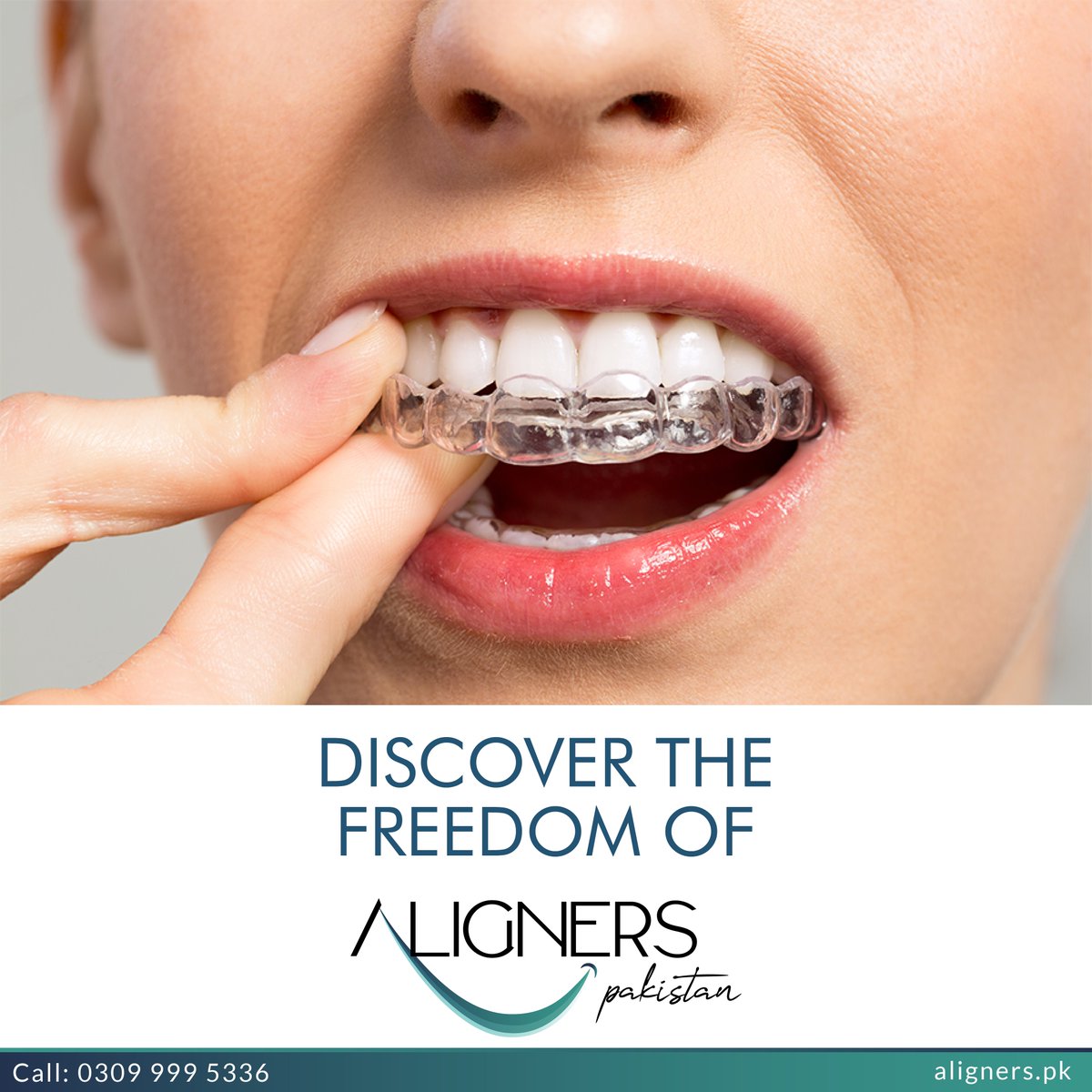 Say Goodbye to Braces, Hello to Freedom!  Call: 𝟎𝟑𝟎𝟗 𝟗𝟗𝟗 𝟓𝟑𝟑𝟔

#AlignerPakistan #Orthodontics #DentalCare #SmileTransformation #smile #braces #dentist #dentistry #teeth #clearaligners #dental #smilemakeover #clearbraces #invisalignsmile  #invisalignjourney #dentalcare