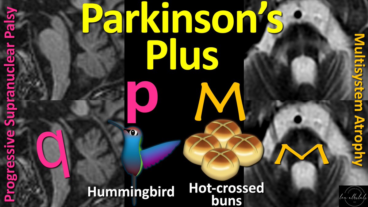 Diagnosing Parkinson’s syndromes is no walk in the park!

Imaging can help—especially in Parkinson’s plus syndromes.

Do YOU remember the signs?

Or do your eyes cross at the hot-cross buns?

Feel bird-brained looking for the hummingbird sign?

Here’s how you can remember!