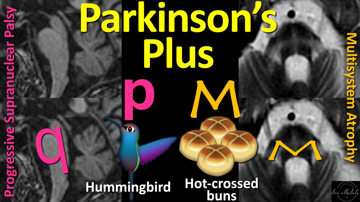 Diagnosing Parkinson’s syndromes is no walk in the park! Imaging can help—especially in Parkinson’s plus syndromes. Do YOU remember the signs? Or do your eyes cross at the hot-cross buns? Feel bird-brained looking for the hummingbird sign? Here’s how you can remember!