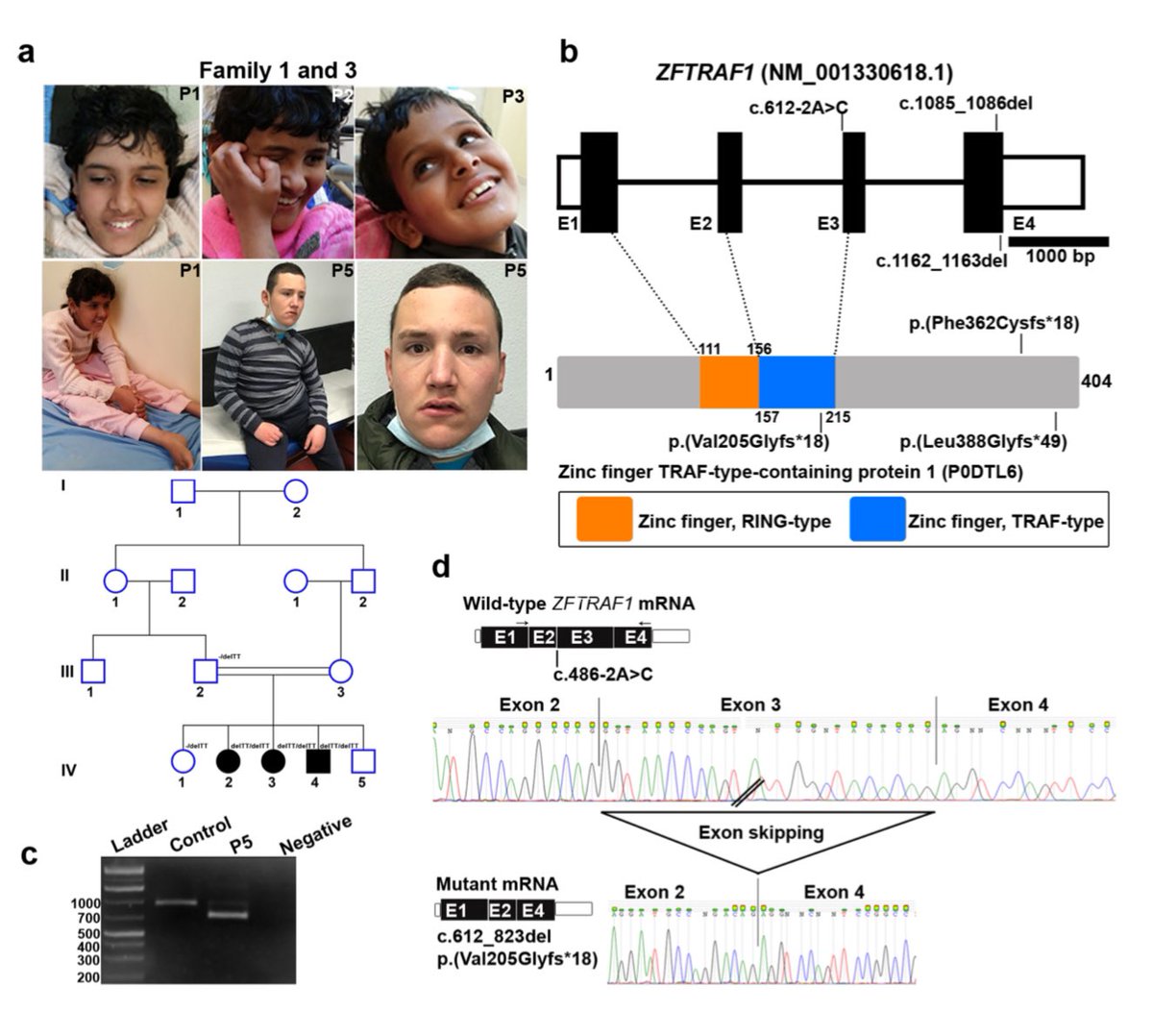 Biallelic loss-of-function variants of ZFTRAF1 cause neurodevelopmental disorder with microcephaly and hypotonia. #RareDisease #Genetics #morbidgene sciencedirect.com/science/articl…