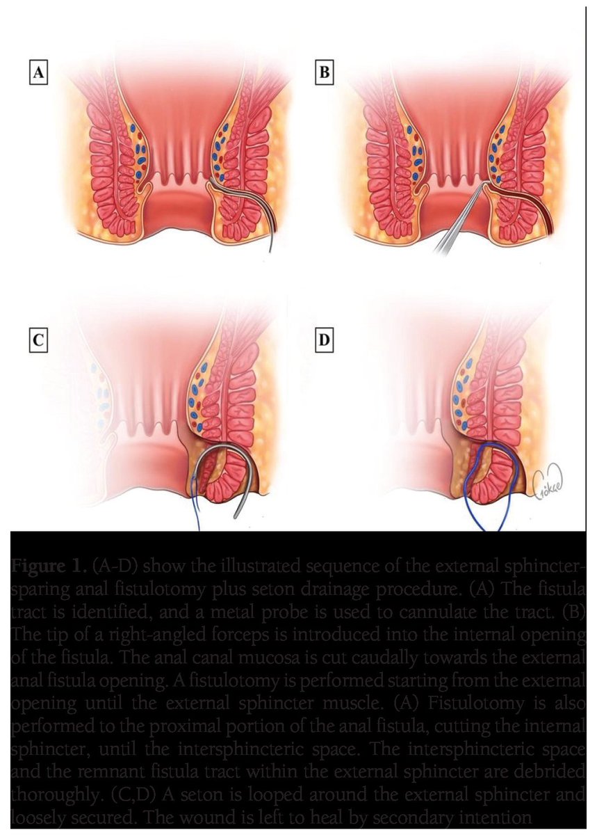 'Exciting news! 🎉 Our article is now published in the Turkish Journal of Colorectal Disease and is available for download as open-access. Dive into our research here: [Link to article] turkishjcrd.com/archives/archi… An external sphincter-sparing #analfistulotomy plus #seton drainage…