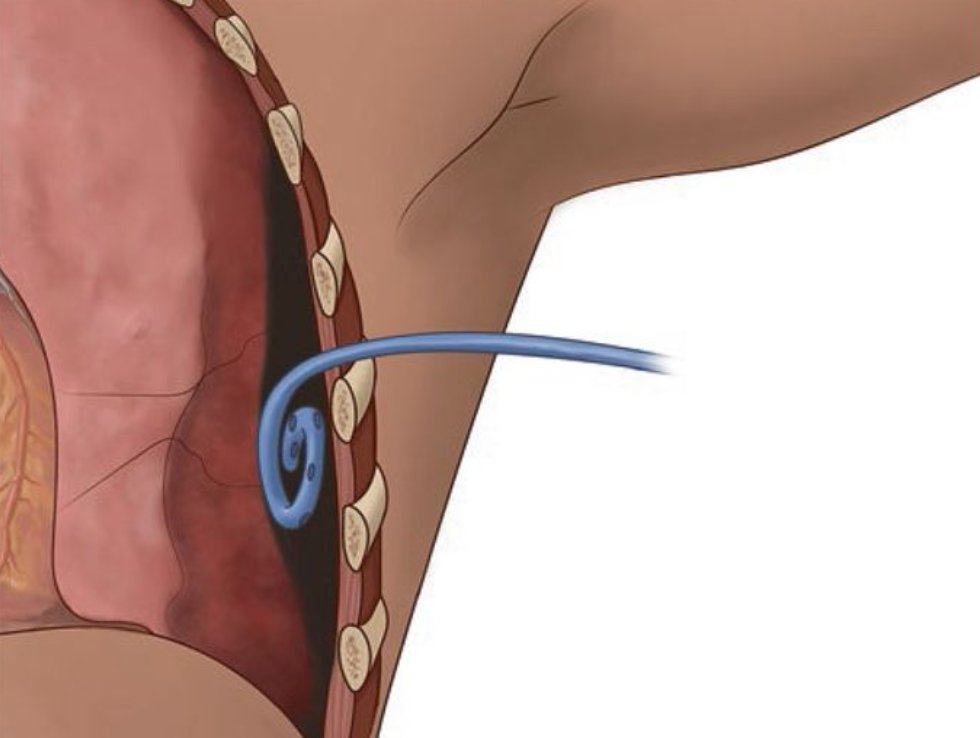 Trauma Surgery & Acute Care Open (TSACO) (@tsaco_aast) on Twitter photo Coming up at 2:00 at the #TCCACS2024 meeting:
Dr. Meghan Lewis presents "Are pigtails all they promised?"
See the open access manuscript by Dr. Lewis and <a href="/georgoff/">Patrick Georgoff, MD</a> in TSACO here:
➡️bit.ly/3JnRDd Coming up at 2:00 at the #TCCACS2024 meeting:
Dr. Meghan Lewis presents "Are pigtails all they promised?"
See the open access manuscript by Dr. Lewis and <a href="/georgoff/">Patrick Georgoff, MD</a> in TSACO here:
➡️bit.ly/3JnRDd