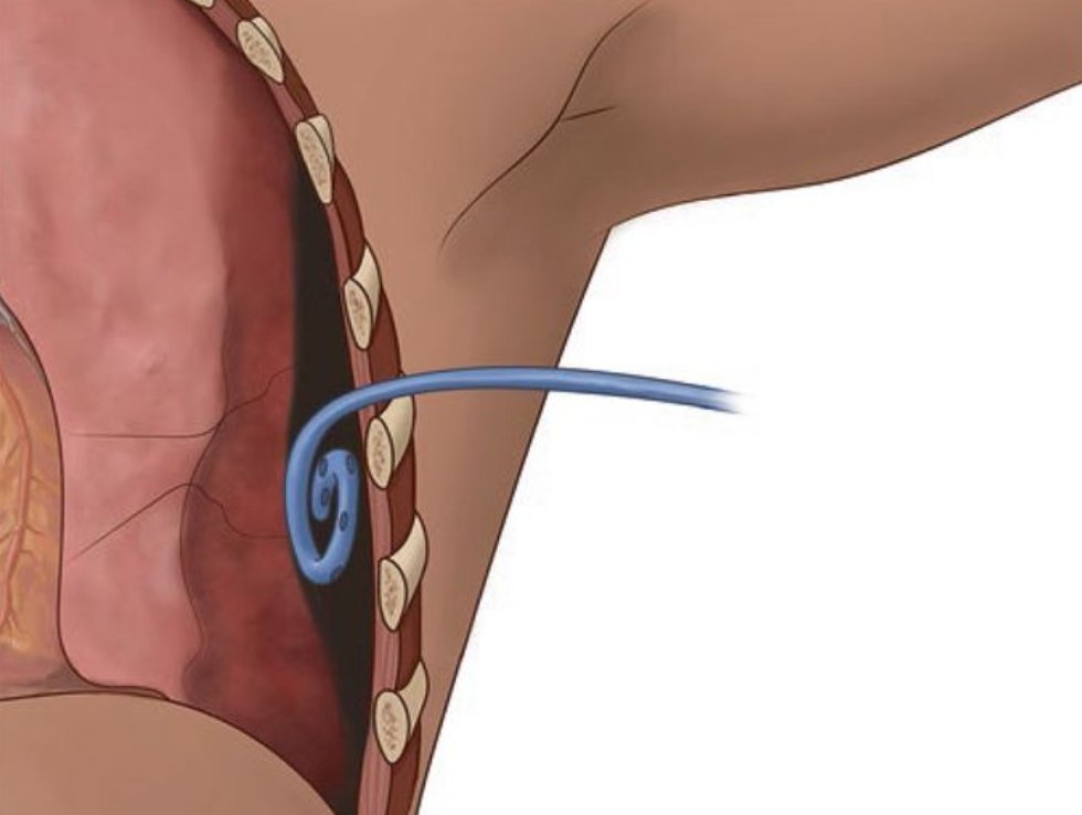 Coming up at 2:00 at the #TCCACS2024 meeting: Dr. Meghan Lewis presents 'Are pigtails all they promised?' See the open access manuscript by Dr. Lewis and @georgoff in TSACO here: ➡️bit.ly/3JnRDd