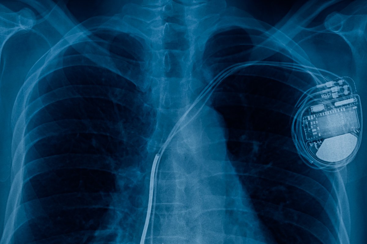 On Episode 11 of The Healthy Matters Podcast, we’re covering everything you need to know about pacemakers, including how they are implanted and work in the body. @drdavidhilden is joined by Dr. Rehan Karim, who helps break it down for us. Listen now at healthymatters.org.