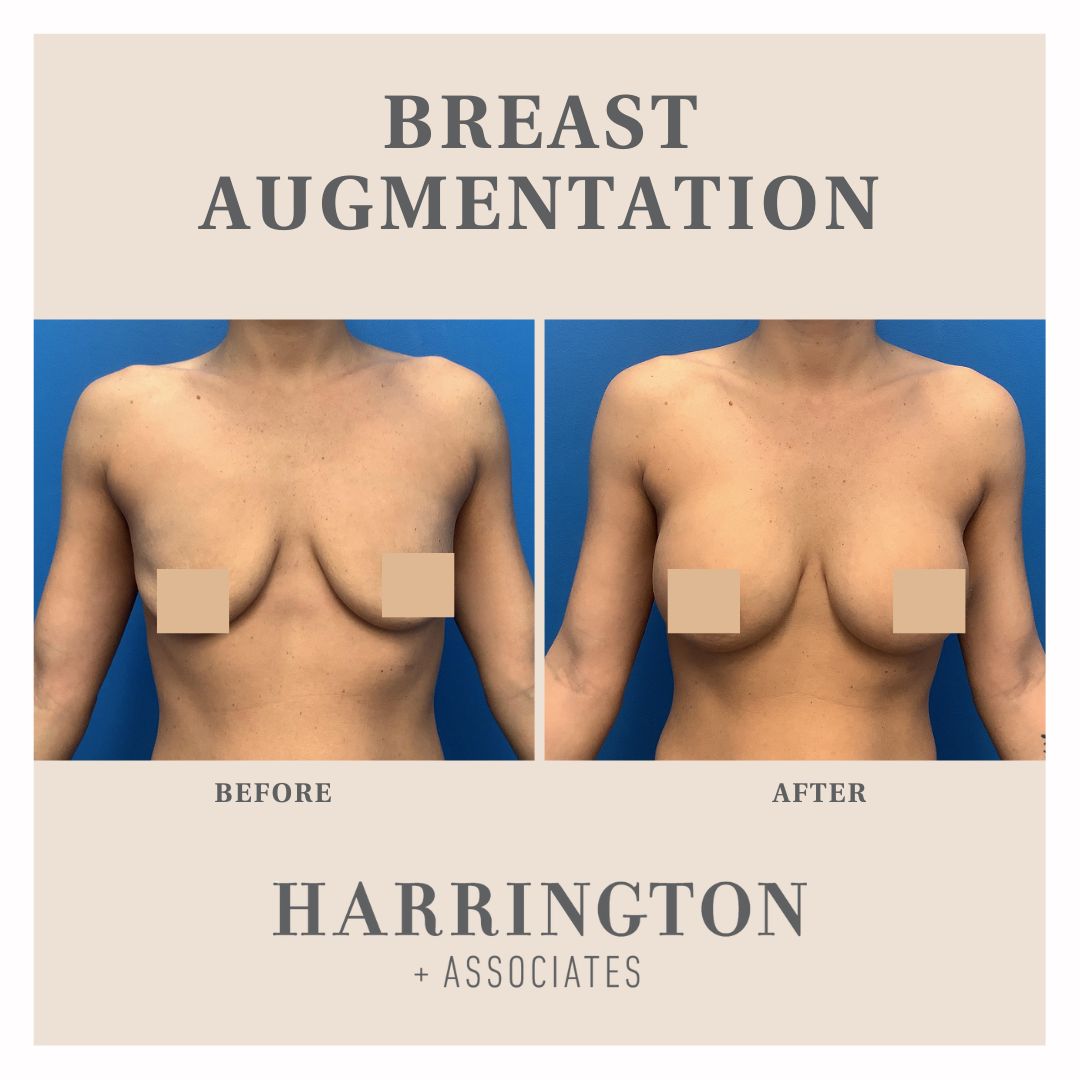 DoctorJenn_HPS's tweet photo. 𝐁𝐫𝐞𝐚𝐬𝐭 𝐀𝐮𝐠𝐦𝐞𝐧𝐭𝐚𝐭𝐢𝐨𝐧

⏱ Timeline: 4 months post-procedure ⁣
➡️ Implant size: 320cc 
👩🏼‍⚕️ Surgeon: Dr. Jennifer Harrington ⁣

📞(651)‍290-7600
💻 https://t.co/gyYcclObjt https://t.co/4YOBQcqcvE
