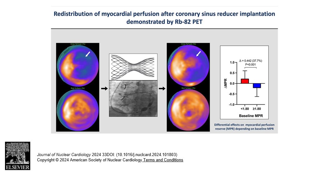 Redistribution of myocardial perfusion by Rb-82 PET occurs after coronary sinus reducer implantation for refractory angina due to advanced coronary artery disease. @KevinCCheng Editorial by Nils Johnson @UTHealthHouston. Read here🔗bit.ly/3w10C1i #CVNuc @MyASNC