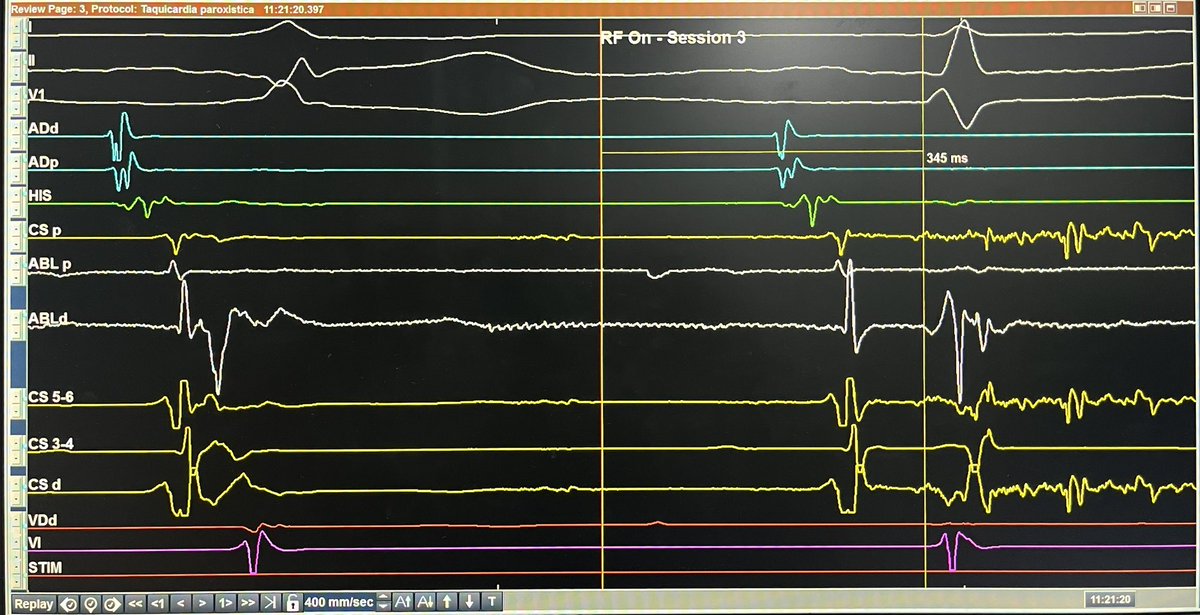 #WPW Fastest RFA time to normalize QRS at 0.33 secs Left posterior AP, mapped with Dr. Jackman approach to assess oblique course of AP, pacing atrium from HRA and LV for ventricle Visible Kent for RFA Done at @hospitalposadas Case done with @GusCostaEP57 and @KamilaOlivera13