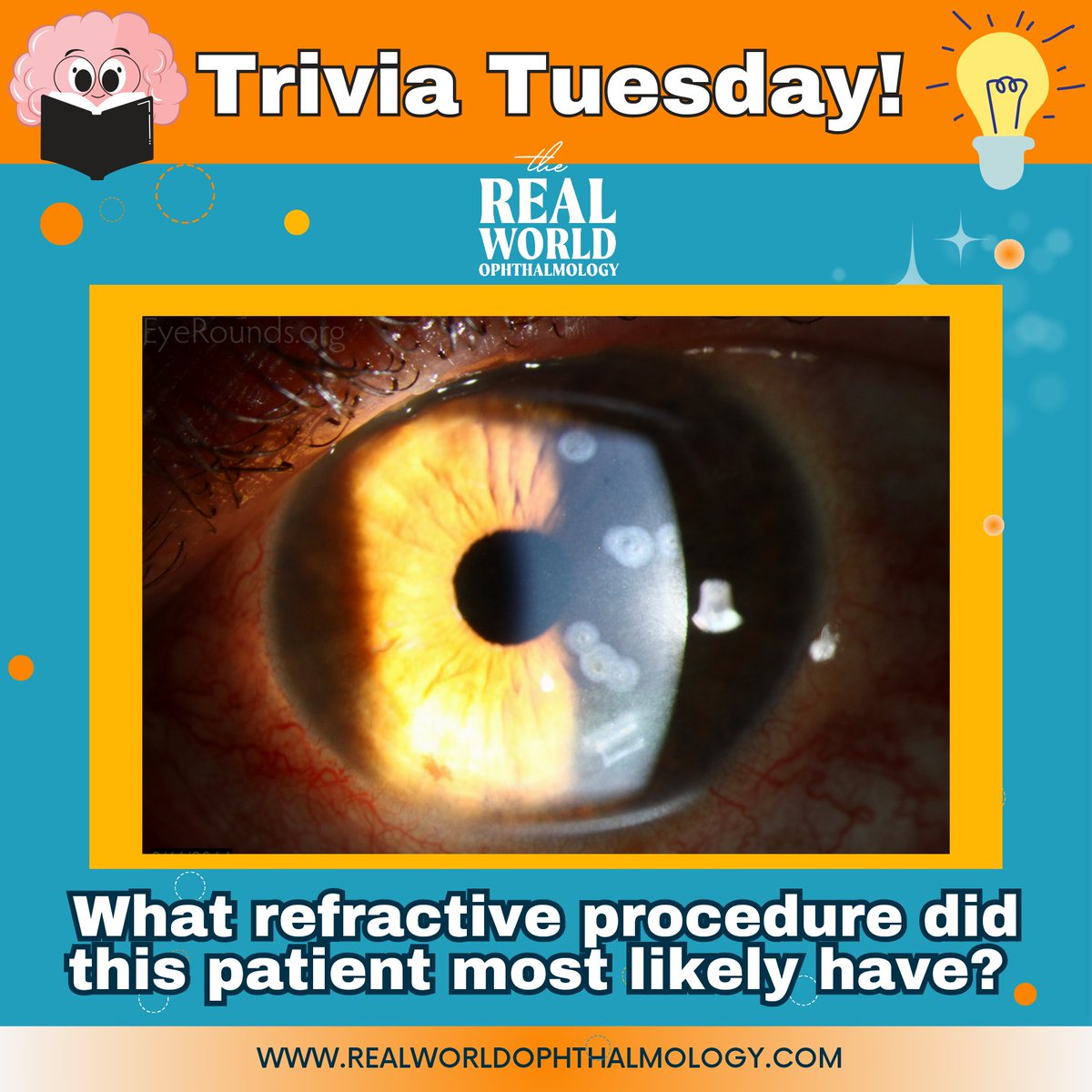 Happy #TriviaTuesday ‼️

A 75 year old patient presents with pain, photophobia, and blurry vision. Their examination shows cell and flare without KPs, corneal edema, and a mature cataract. 

What corneal procedure did the patient whose cornea is shown in this figure undergo?🤔