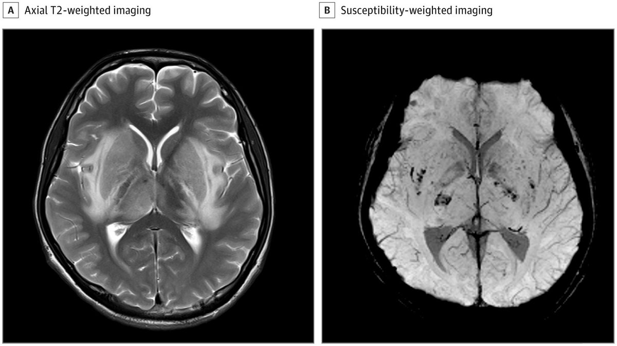Case report: a 17-year-old boy with reduced consciousness and T2-weighted hyperintensity, focal diffusion restriction, and microhemorrhages within the deep gray nuclei and surrounding white matter. ja.ma/49wJfDm