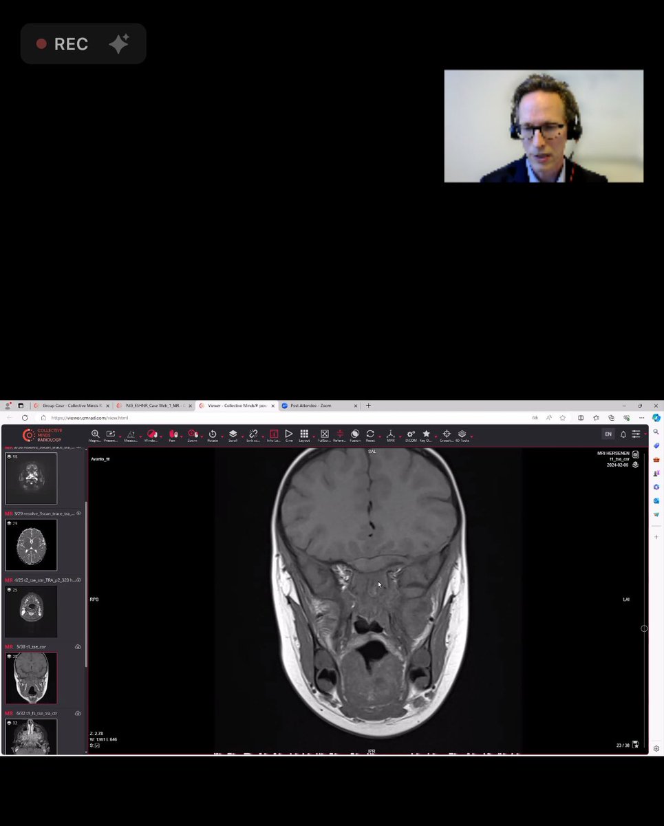 ESHNR (@eshnrsociety) on Twitter photo Welcome to our today‘s case based webinar
Dr. Pim de Graaf from Amsterdam at work
#eshnr #ashnr <a href="/ASHNRSociety/">ASHNR</a> <a href="/YPekcevik/">Yeliz Pekçevik, MD</a> <a href="/Umida_rad/">Umida Abdullaeva</a> <a href="/jussihirvonen/">Jussi Hirvonen</a> Welcome to our today‘s case based webinar
Dr. Pim de Graaf from Amsterdam at work
#eshnr #ashnr <a href="/ASHNRSociety/">ASHNR</a> <a href="/YPekcevik/">Yeliz Pekçevik, MD</a> <a href="/Umida_rad/">Umida Abdullaeva</a> <a href="/jussihirvonen/">Jussi Hirvonen</a>