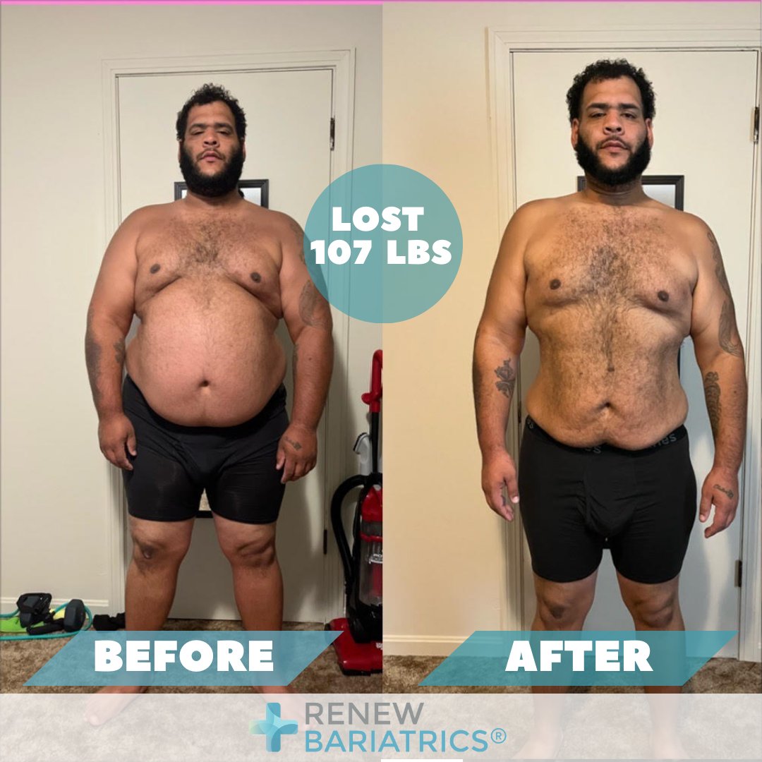 RenewBariatrics's tweet image. 🌟 Celebrating an incredible journey! Starting at 375lbs and now at 268lbs, they've achieved remarkable progress. 💪 Tying shoes without getting out of breath and diving into boxing, their story is truly inspiring. Keep it up! 🥊👟 #WeightLossSuccess #BoxingJourney