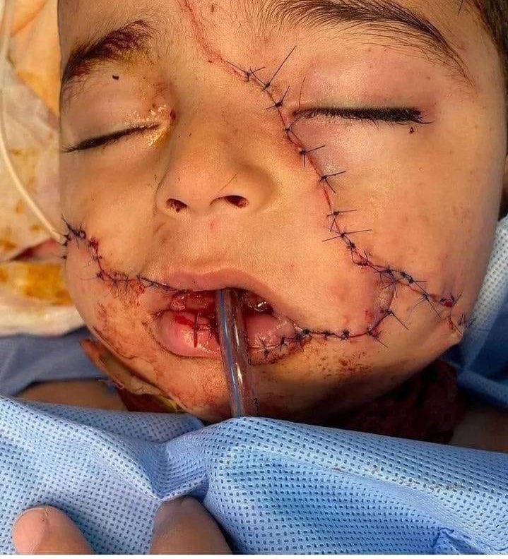Il volto è di Gaza😔 Le cicatrici di Israele. #GazaGenocide2024 #IsraeliTerrorists #Netanyahu #IsraelNewNazism