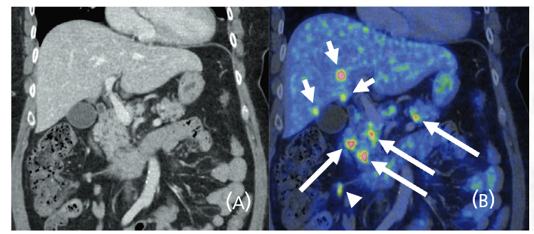 ⁉️Extra-abdo mets in advanced SB/PNETs👉🏻look for them to assess full extent disease PNETs 13% > SB NETs 34% on Ga68-PET-CT☢️ Of 100 advanced NETs: extra-abdo mets in SB➡️23🦴| 6🫁| 2🫀| 2👁️| 5 pancreas PNET➡️ 10🦴| 2🫁 🤔How integrate in management? 📝tinyurl.com/38kp9xwm