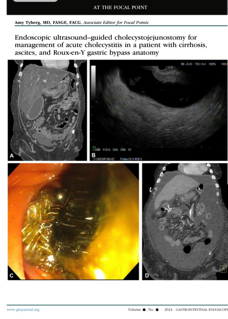 Nice job @nataliejowilson #Tessa Herman @mabdallahmd in showcasing the case of EUS GBD in RYGB & décompensâted cirrhosis /ascites @GIE_Journal @BilalMohammadMD url.us.m.mimecastprotect.com/s/5aj0CADo0Efr…