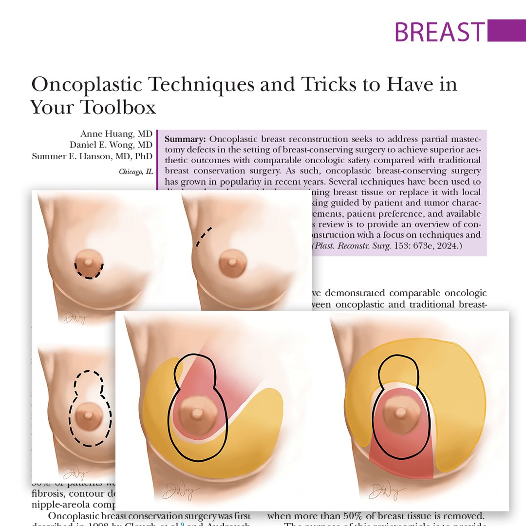 In this #PRSJournal article, the purpose of this study is to provide an overview of considerations in #Oncoplastic #BreastReconstruction with a focus on techniques and tips to achieve optimal outcomes. Read about it here: bit.ly/OncoplasticTri…